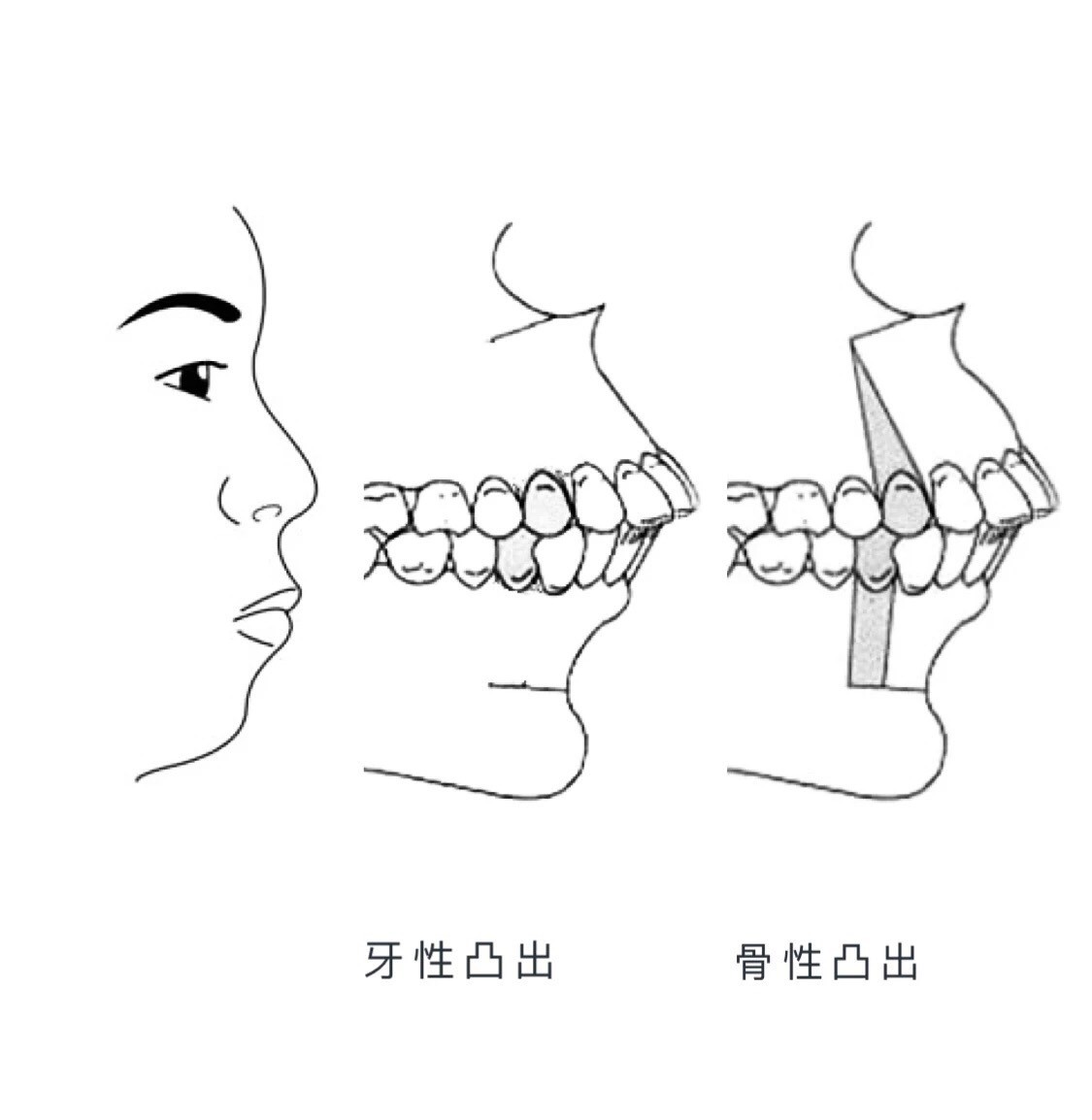 以为不严重,,没想到凸嘴一点气质都没有了,求看,谢谢!