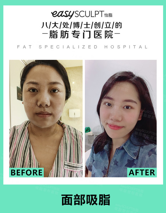 面部吸脂后松弛怎么办