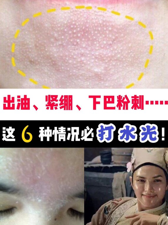 出油,紧绷,下巴粉刺!这6种情况必打水光!