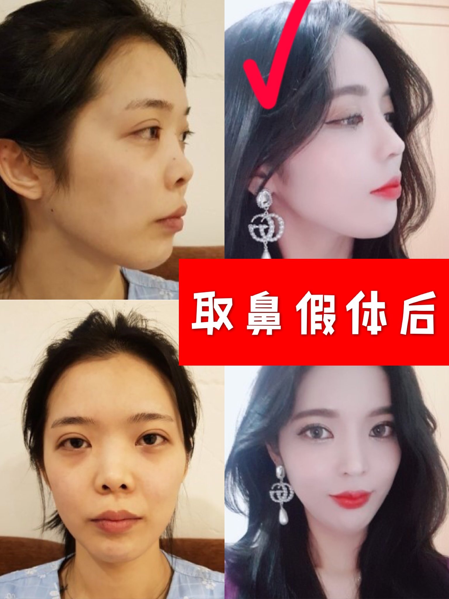 取鼻假体后,我的鼻子变好看了很多
