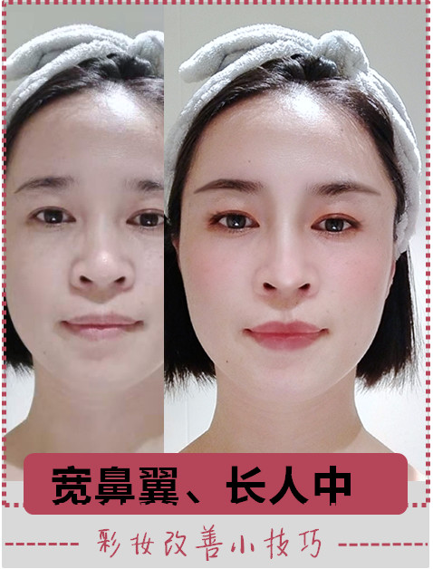 宽鼻翼,长人中的改善小技巧