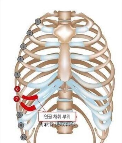 ▋ 既然避免不了取出肋软骨步骤,为什么有半肋和全肋之分呢?