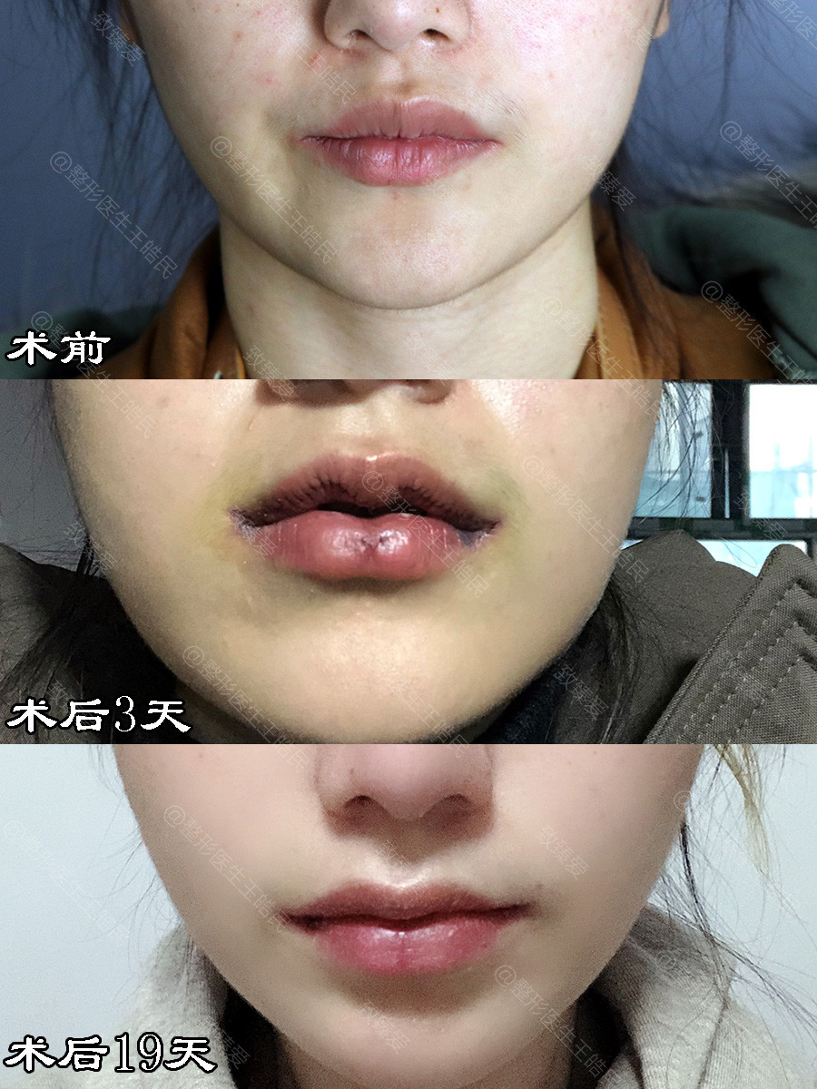 m唇手术会不会留下明显的疤痕