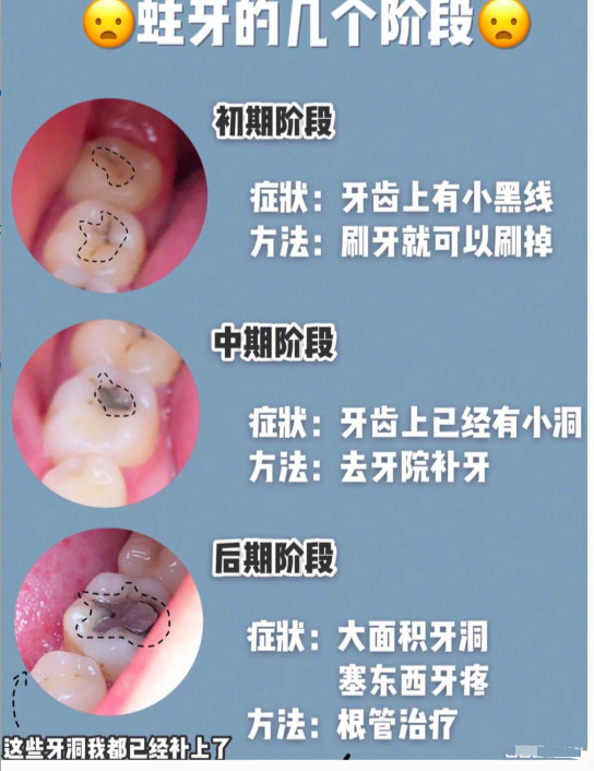下面整理了一些牙齿有关的知识 蛀牙的几个阶段 初期阶段(可控) 症状
