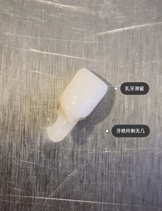 分享我的美牙篇(牙齿贴面种植牙) 下篇 3 乳牙脱落了 2016年的11月