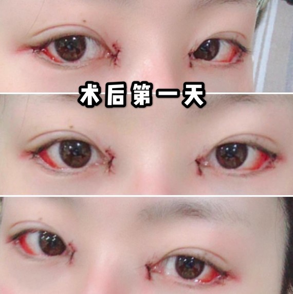 今天来康康我好姐妹做的眼睛,太成功了99是我身边做