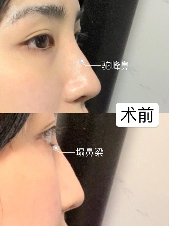 关于隆鼻我不敢含糊,现在恢复的超自然