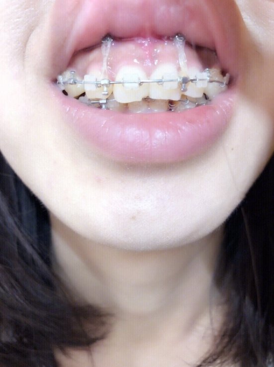 年龄:28症状:牙性骨性龅牙,天包地 牙套类型:陶瓷牙套(隐形托槽矫正)