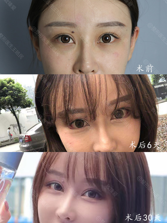 针对你的问题,我的建议是:下睑下至 开外眼角改善眼型.