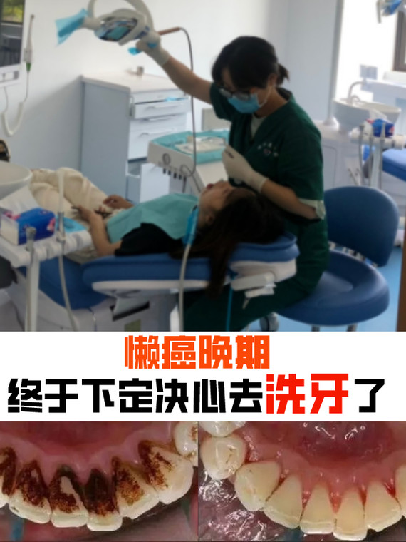 洗牙/洁牙