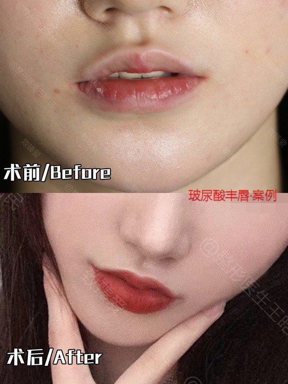 唇部手术后闭不上嘴,导致这种情况出现的原因可能是两种