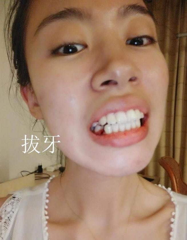 骨性龅牙嘴凸 下巴后缩,两年牙齿矫正的蜕变