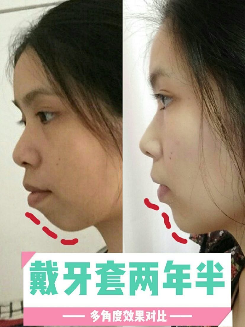 矫正牙齿两年半,做梦都要笑醒了!