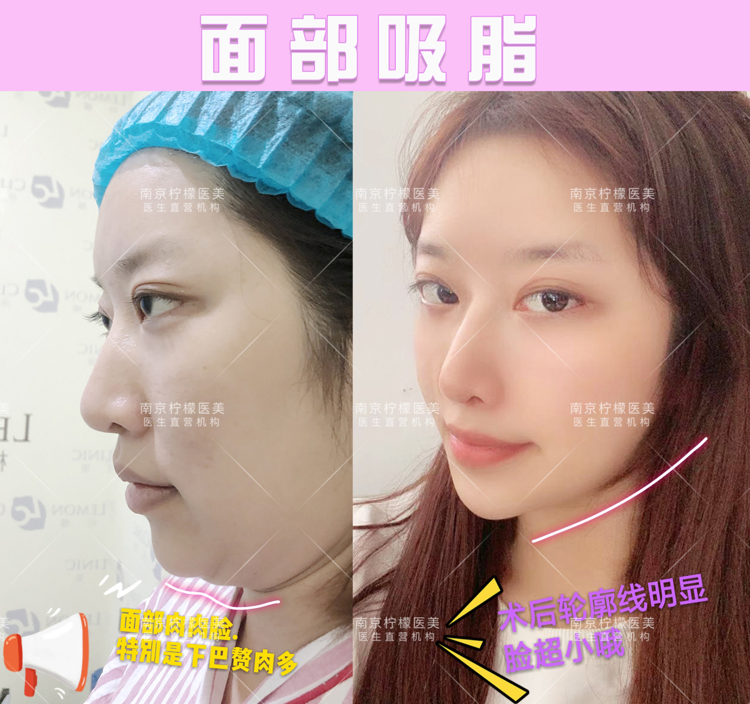 双下巴怎么消除?