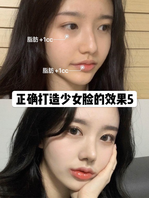 别人脂肪填充后是少女脸,而你却是包子脸?