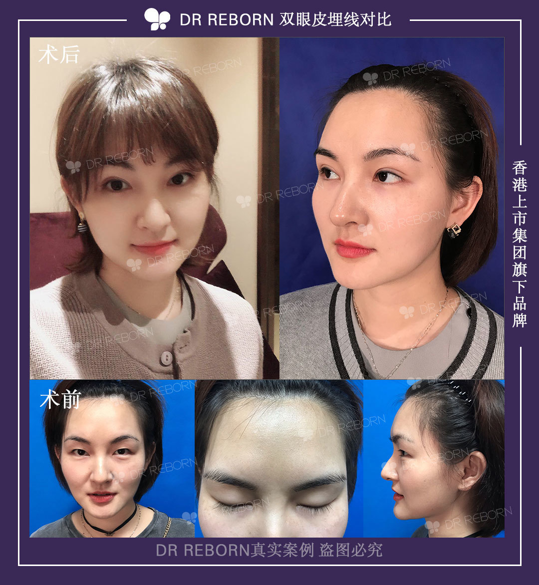整成上面眼睛需要开外眼角还是下至