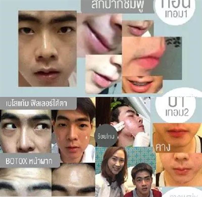 小哥花74万整容从丑男变网红!