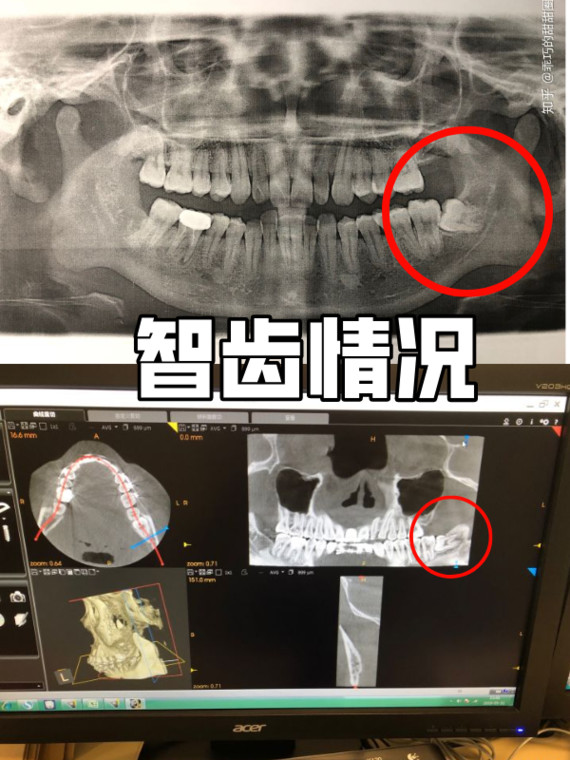 才知道自己左右下各有一颗智齿的 花费:手术包括牙片ct拔牙费用两千多