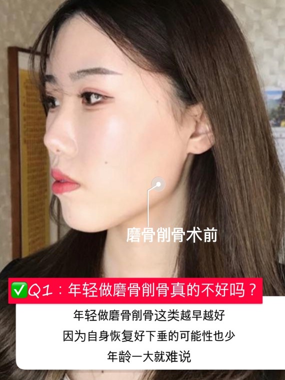 关于磨骨削骨瘦脸,整理出了一份攻略-面部轮廓对颜值_圈子-新氧美容