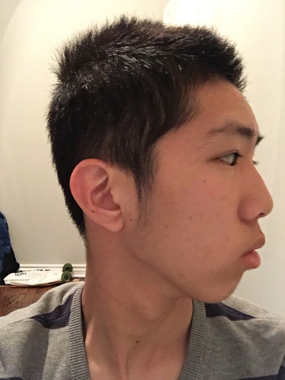 正畸5个月,侧脸有变化了?