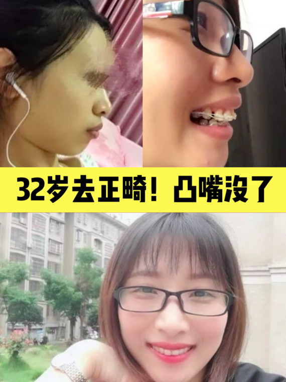 32大龄 骨性,放弃正颌选择正畸!