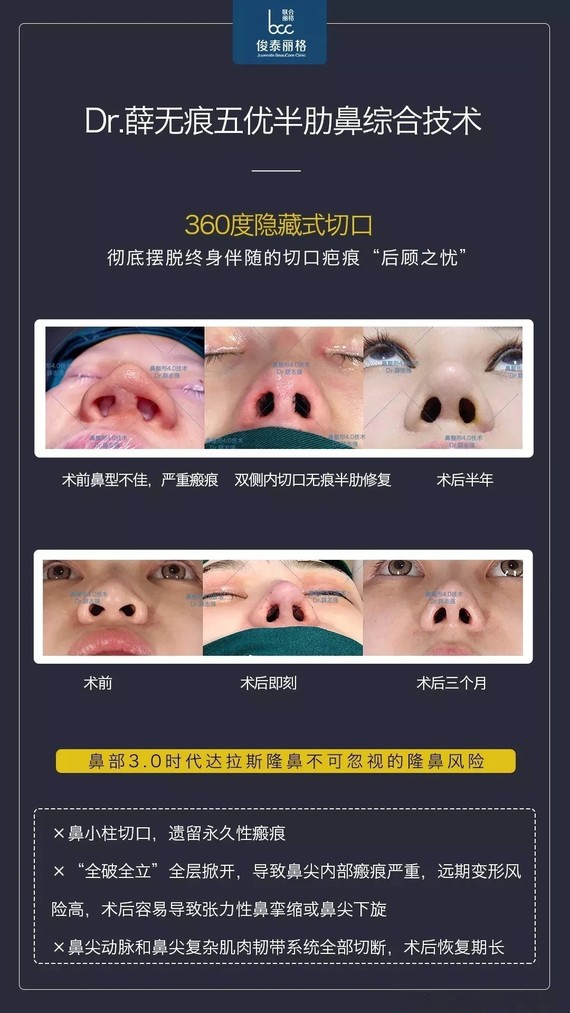 989191鼻小柱疤痕是个很常见的隆鼻术后问题,这