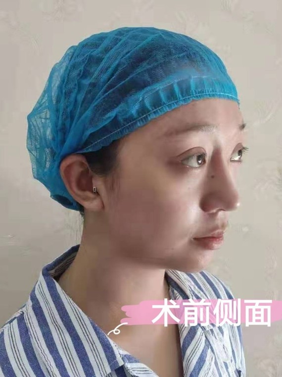 求美者整体的五官还可以,但是整体缺少轮廓感,眉弓低