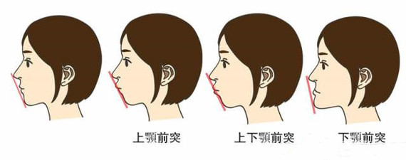 从照片上可以看出,小颌畸形时下颏后缩,颏颈角,也就是下颌与