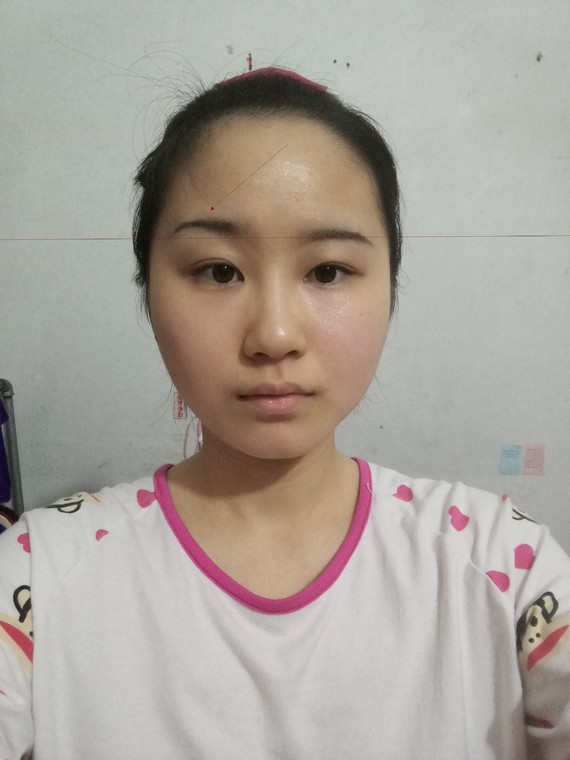 你好,很高兴为你解答,我觉得你的面部最大的问题是左右脸不对称导致的