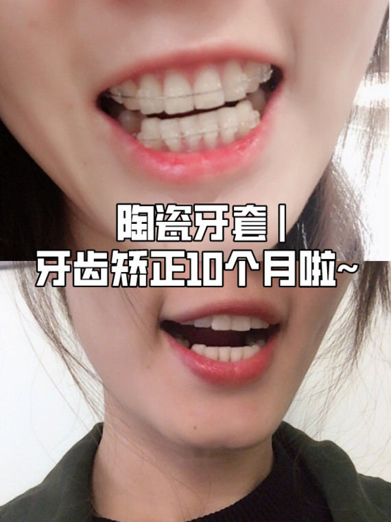 上了 矫正原因 小姐姐觉得目前的牙齿相对于整张脸是宽的,所以拔牙4颗