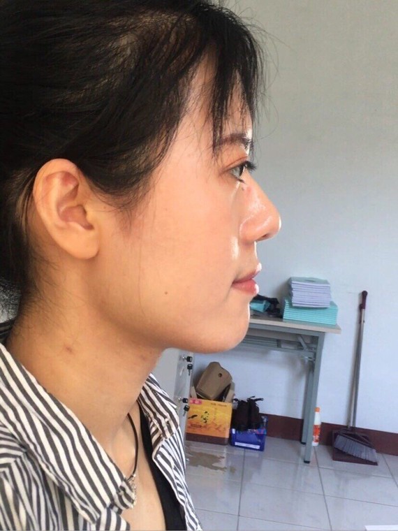 轻微的眼突,鼻基底有点凹陷,所以稍微有点嘴凸,下颌线不够清晰