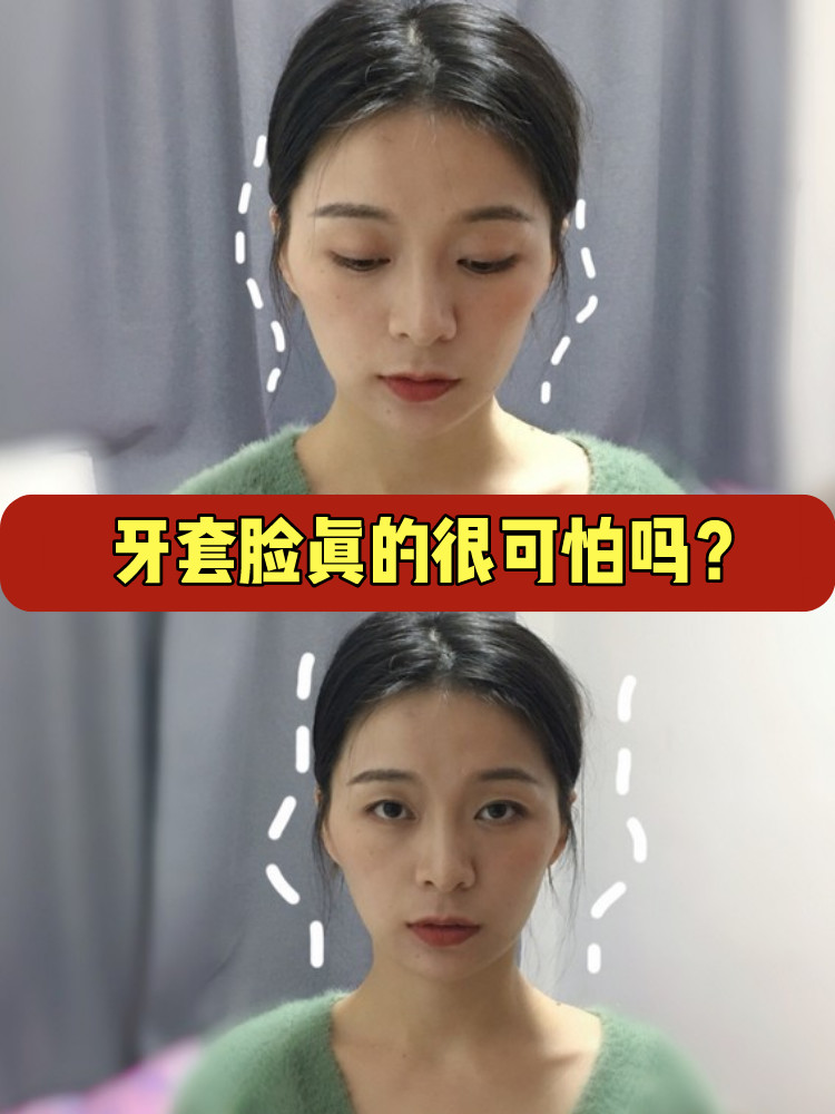 戴牙套以后,牙套脸真的严重吗?