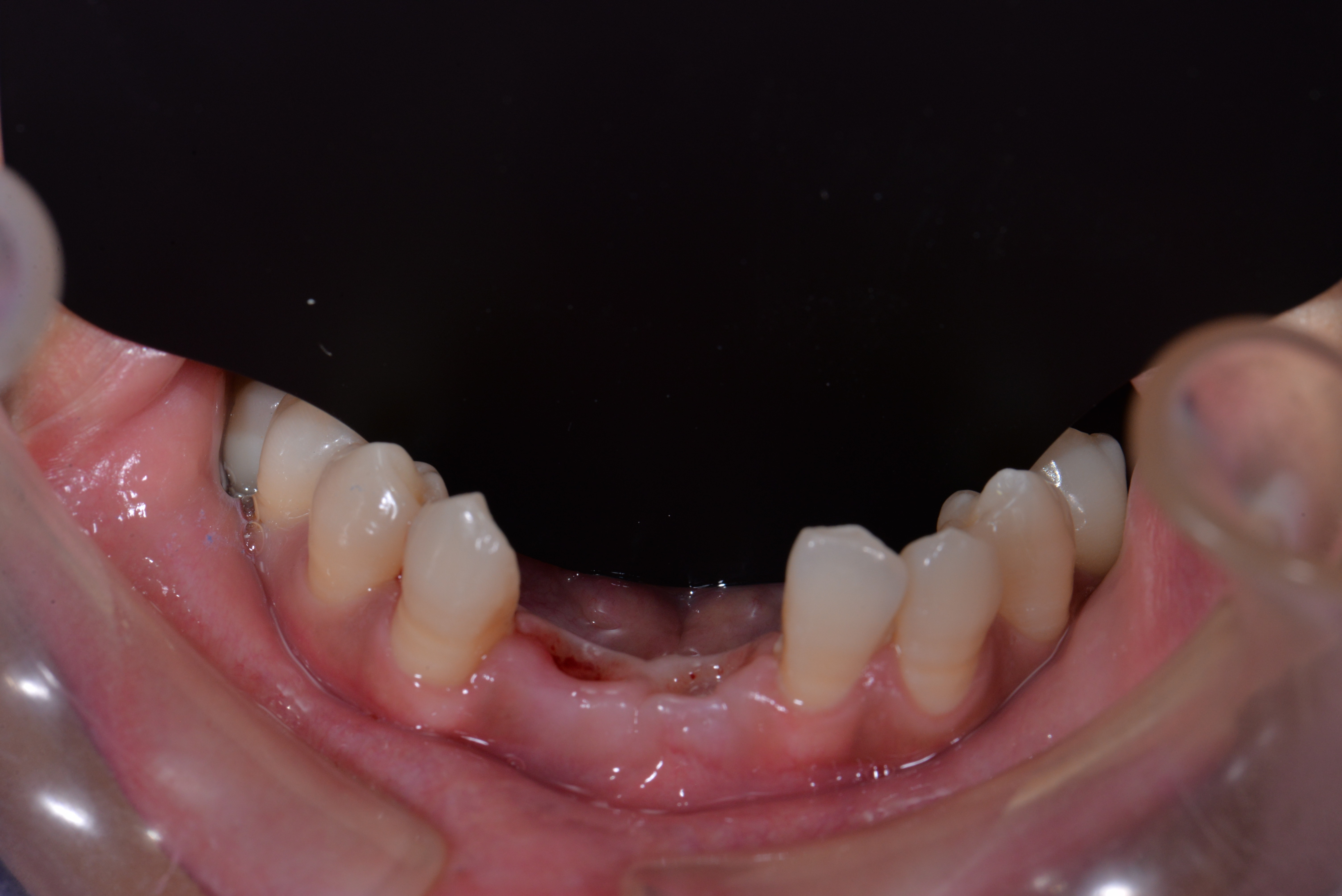 种植牙的过程分几步?半口全口种几颗?