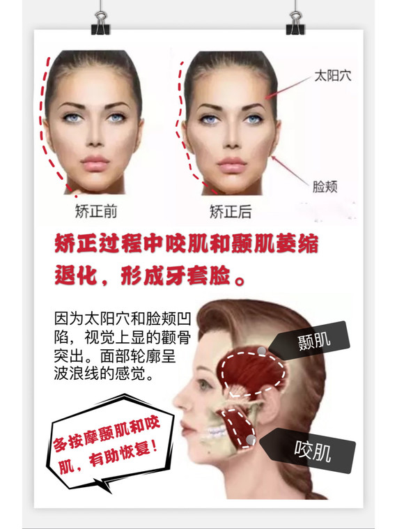 牙齿矫正过程中,人长期无法正常咀嚼硬物,使咬肌和颞肌萎缩退化导致