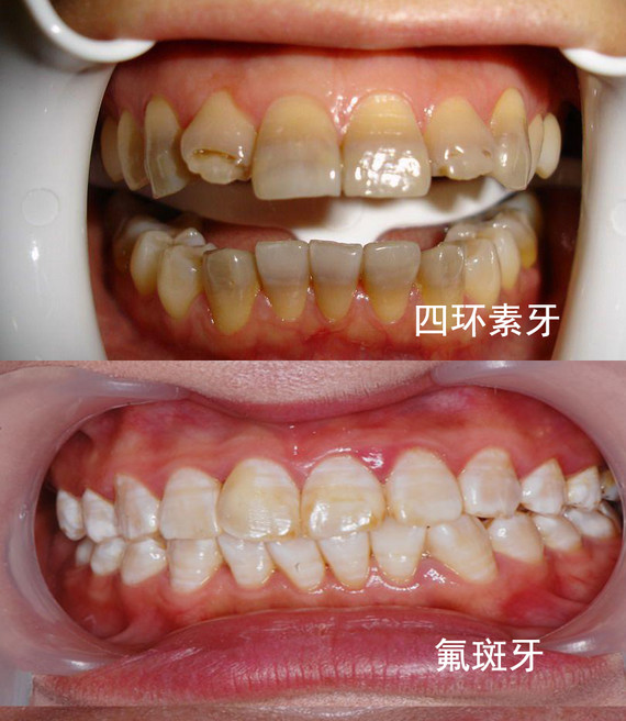 而使牙齿变色的一种内源性变色牙