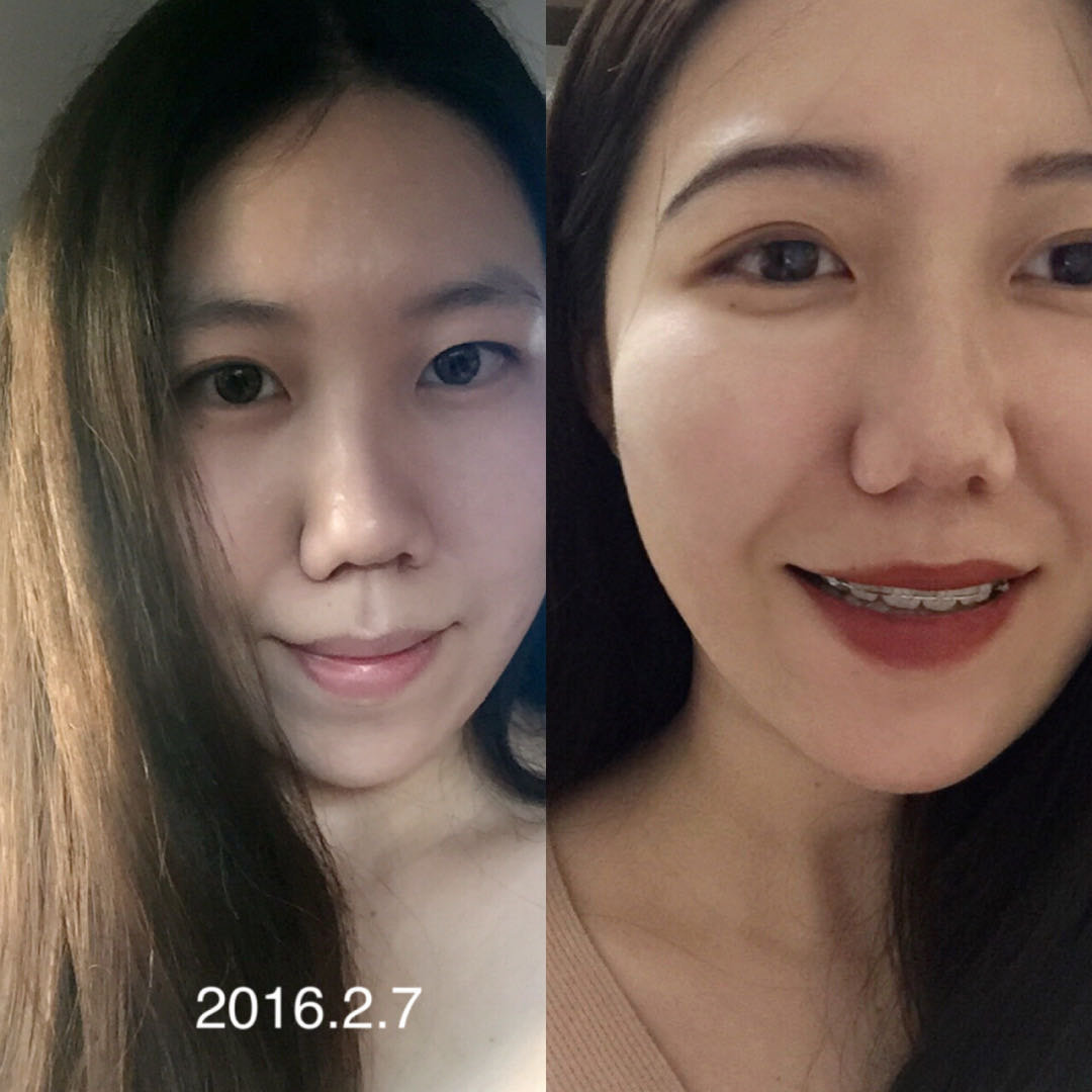戴牙套660天纠正凸嘴!
