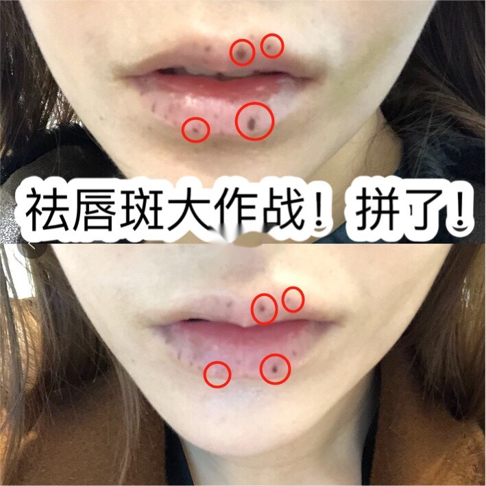 激光祛唇斑无美颜无滤镜真实分享激光祛唇斑