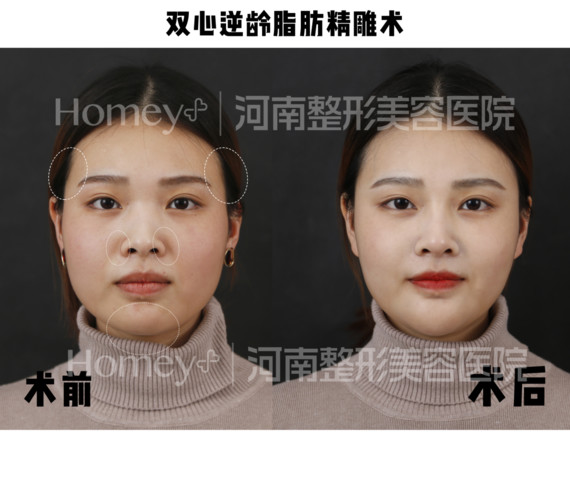 你好,我是河南整形美容医院刘乾坤医生,很高兴能回答_圈子-新氧美容