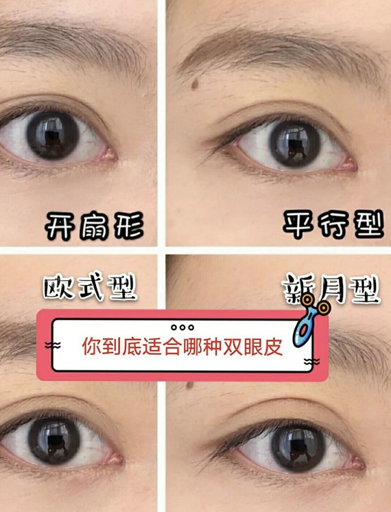 这种双眼皮的特点是双眼皮褶皱和上眼睑睑缘基本平行,内,中,外侧的