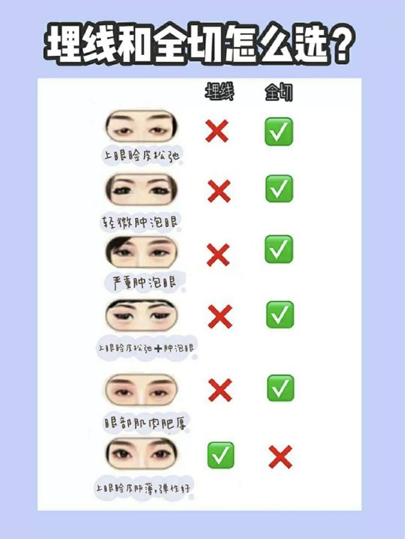 【武汉美基元】双眼皮手术大公开|自测下你适合哪种