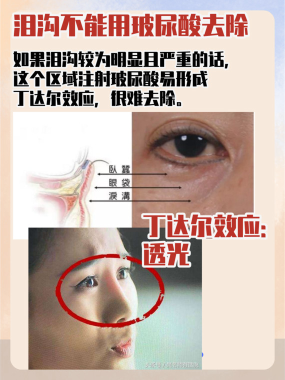 关于初老的标志线:泪沟眼_圈子-新氧美容整形