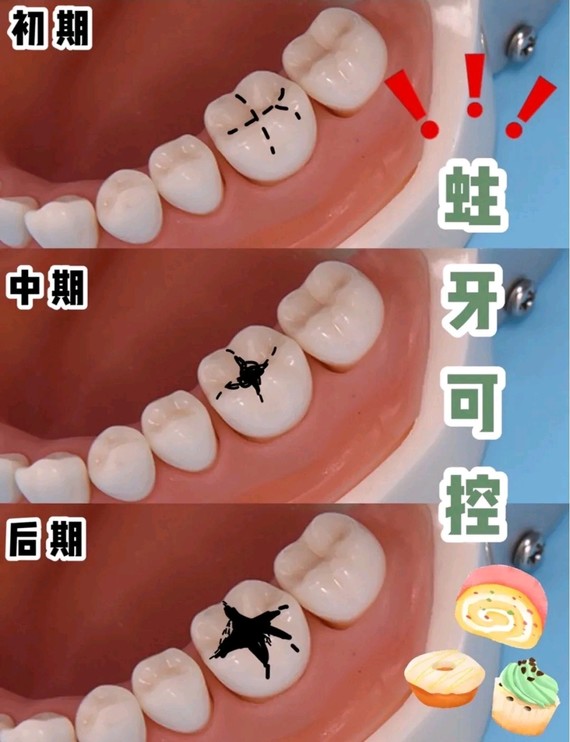 蛀牙的几个阶段