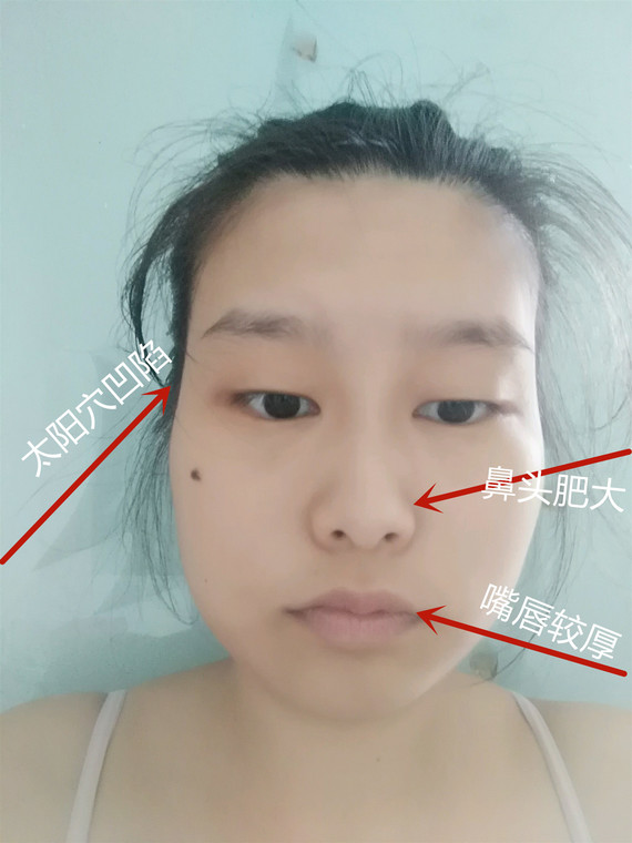 同时,面颊两侧的脂肪堆积比较多,所以看起来更像上窄下宽的"葫芦脸"