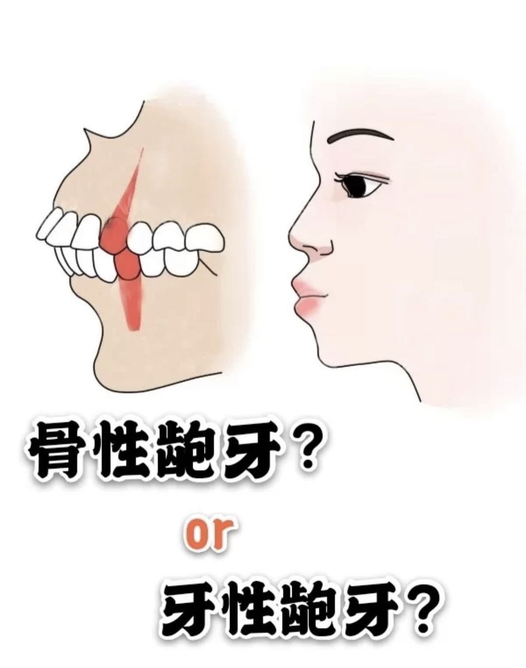如何区分骨性龅牙or牙性龅牙?