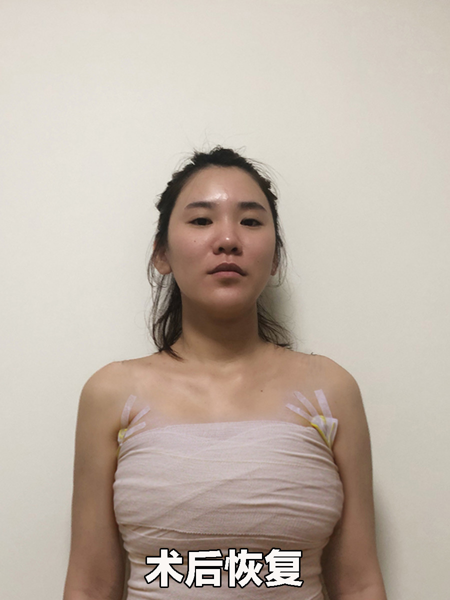 其实我们乳房由乳腺,脂肪,胸大肌等组成.