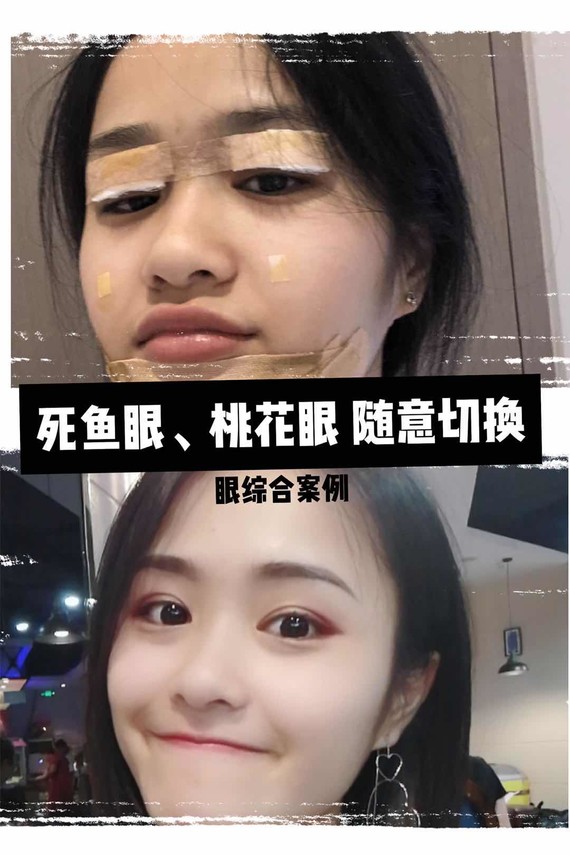 是双的 感觉缺少了点层次感,感觉有点寡淡,朋友还老开玩笑说是死鱼眼!