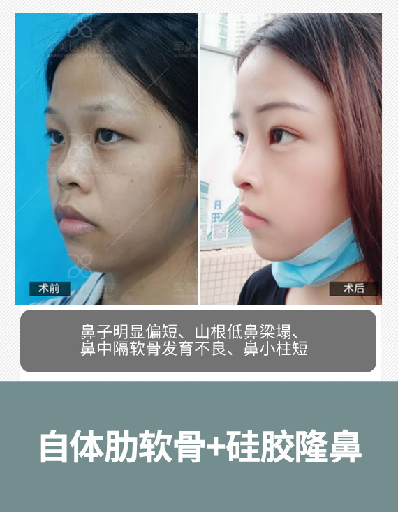 塌鼻子拯救指南!