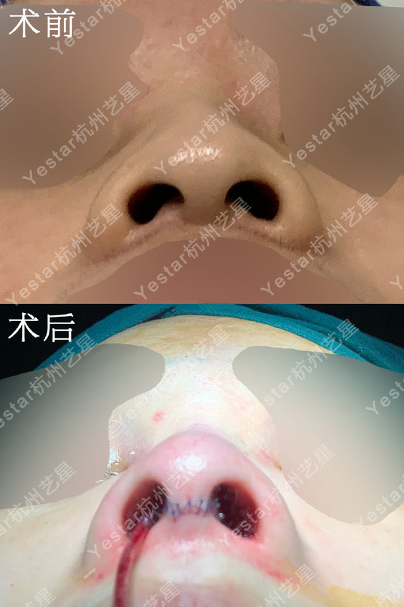 【鼻尖下垂】此案例术前主要是鼻小柱短小,发育薄弱