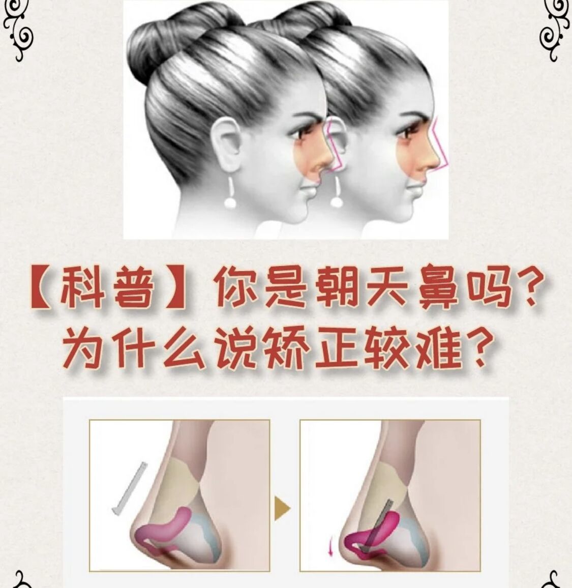 【武汉美基元【科普】你是朝天鼻吗?