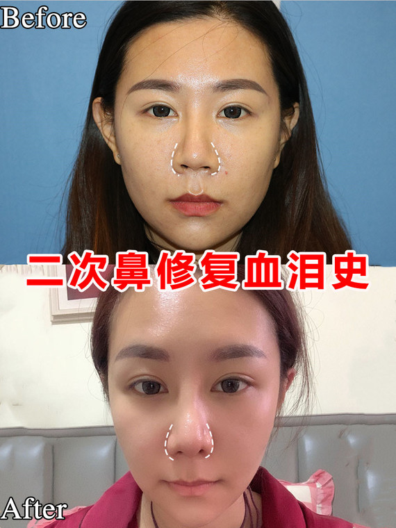 鼻梁弧度不协调,鼻中隔偏曲,鼻头鼻翼稍显宽大,鼻子显得僵硬.